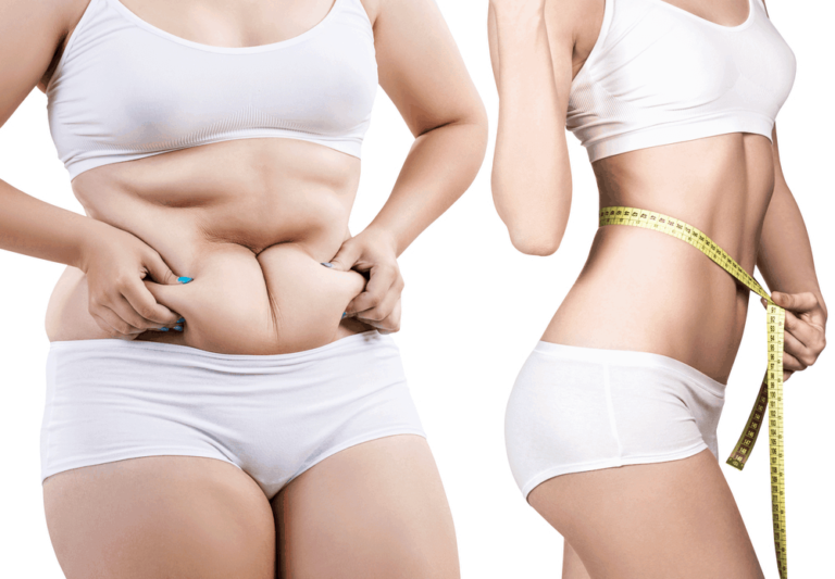 What Are Some Common Misconceptions About Liposuction?